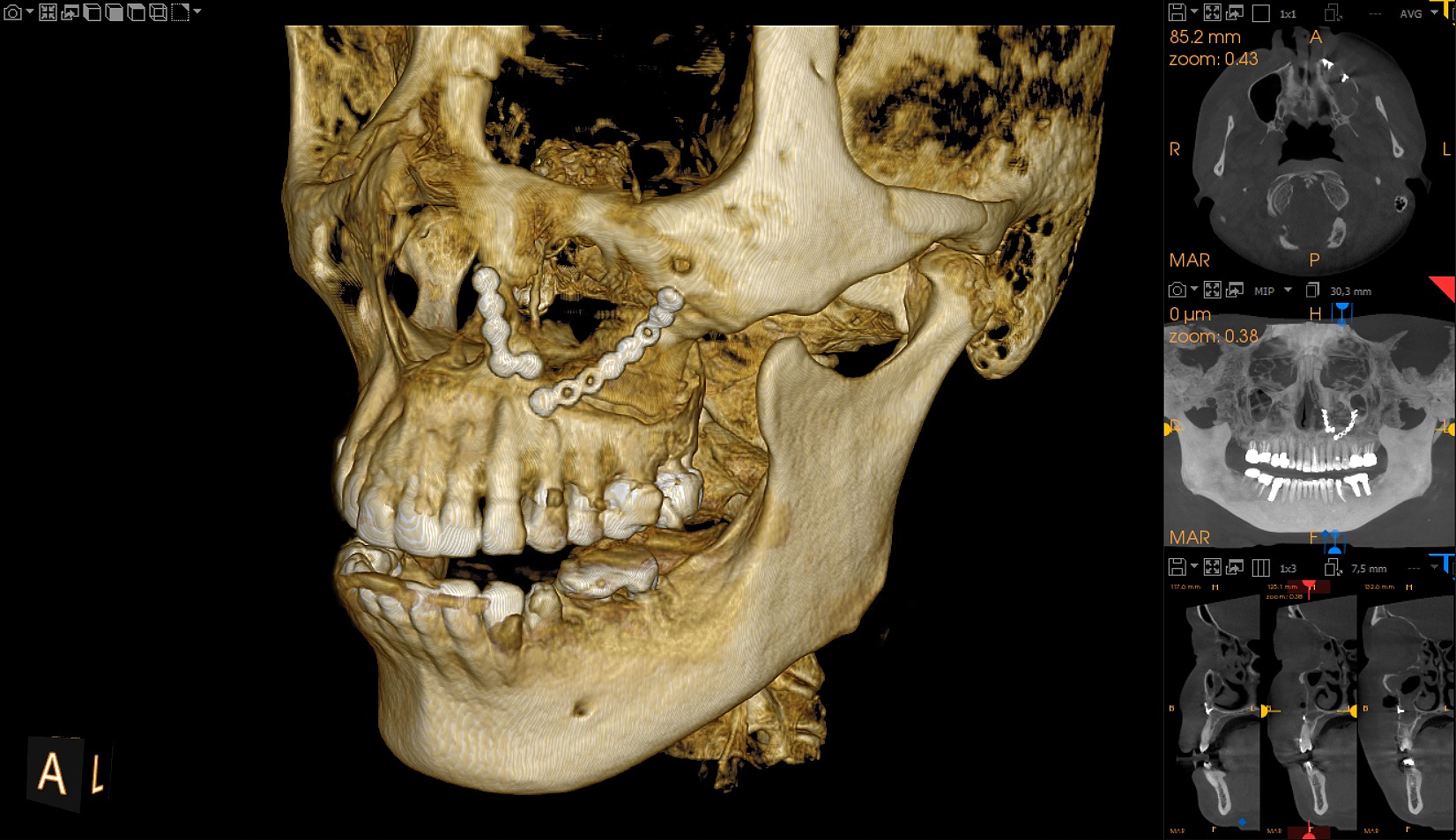 CBCT Imaging System