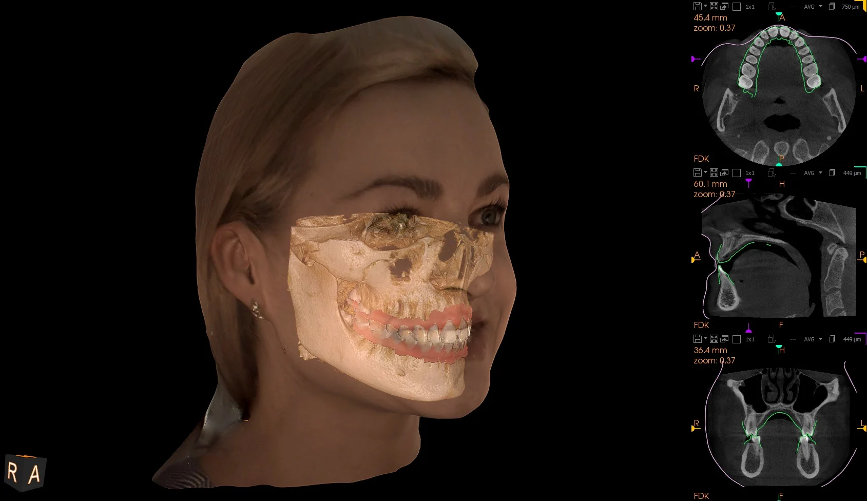 CBCT View 1