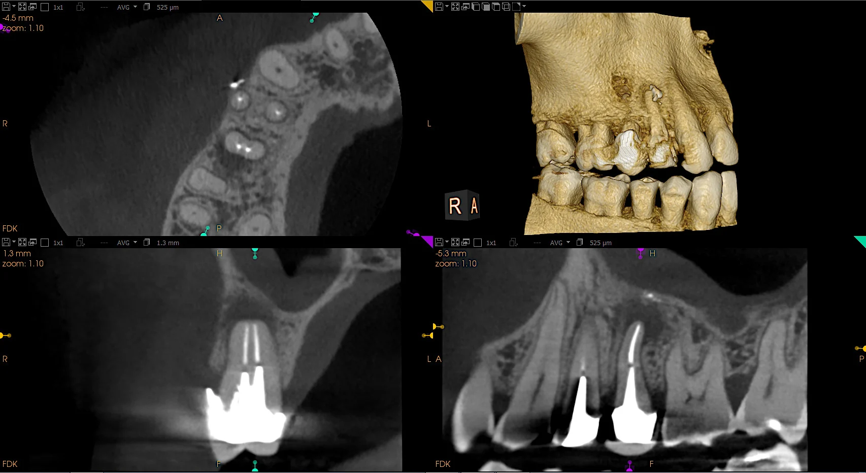 CBCT View 3