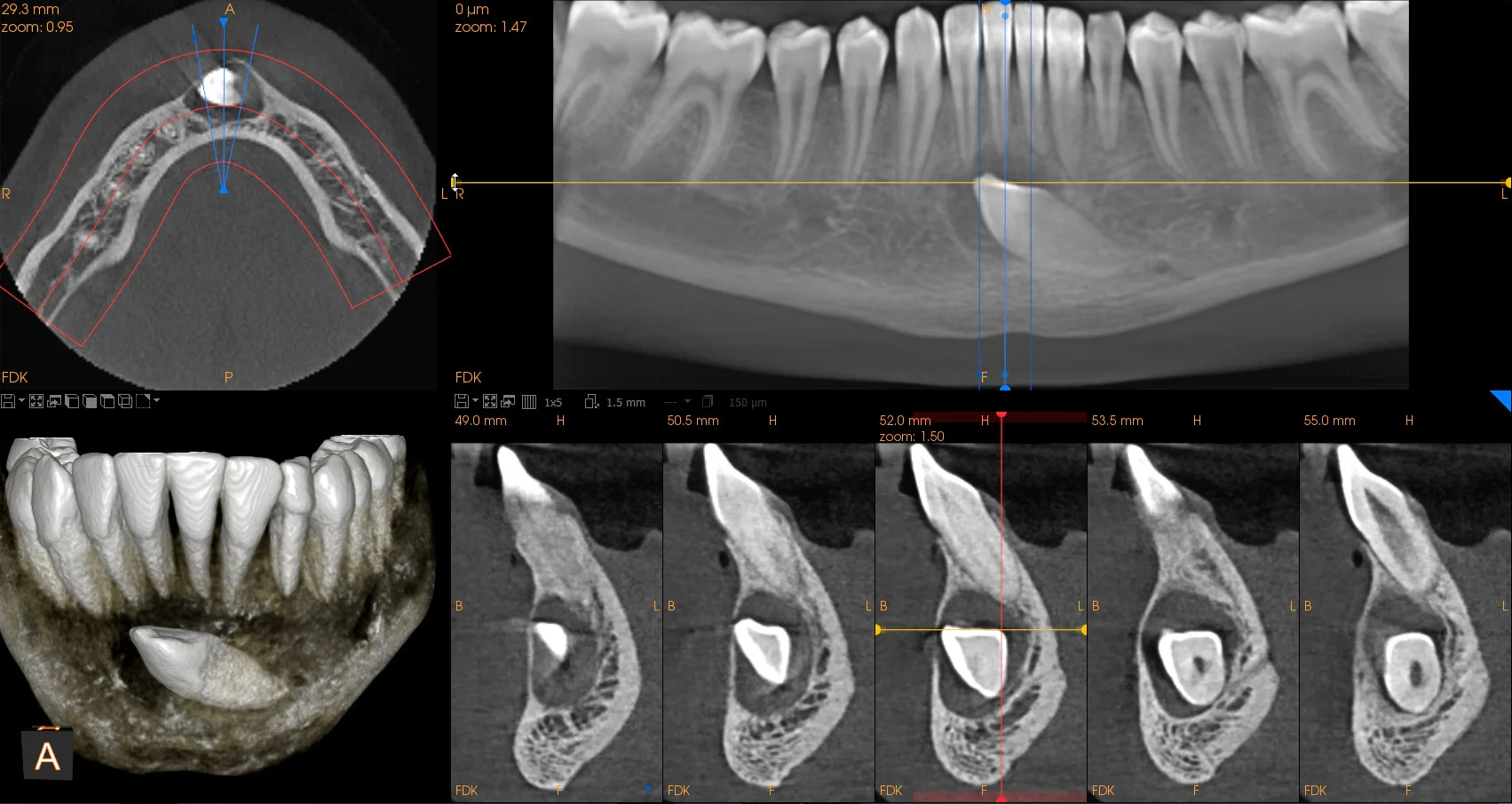 CBCT View 4