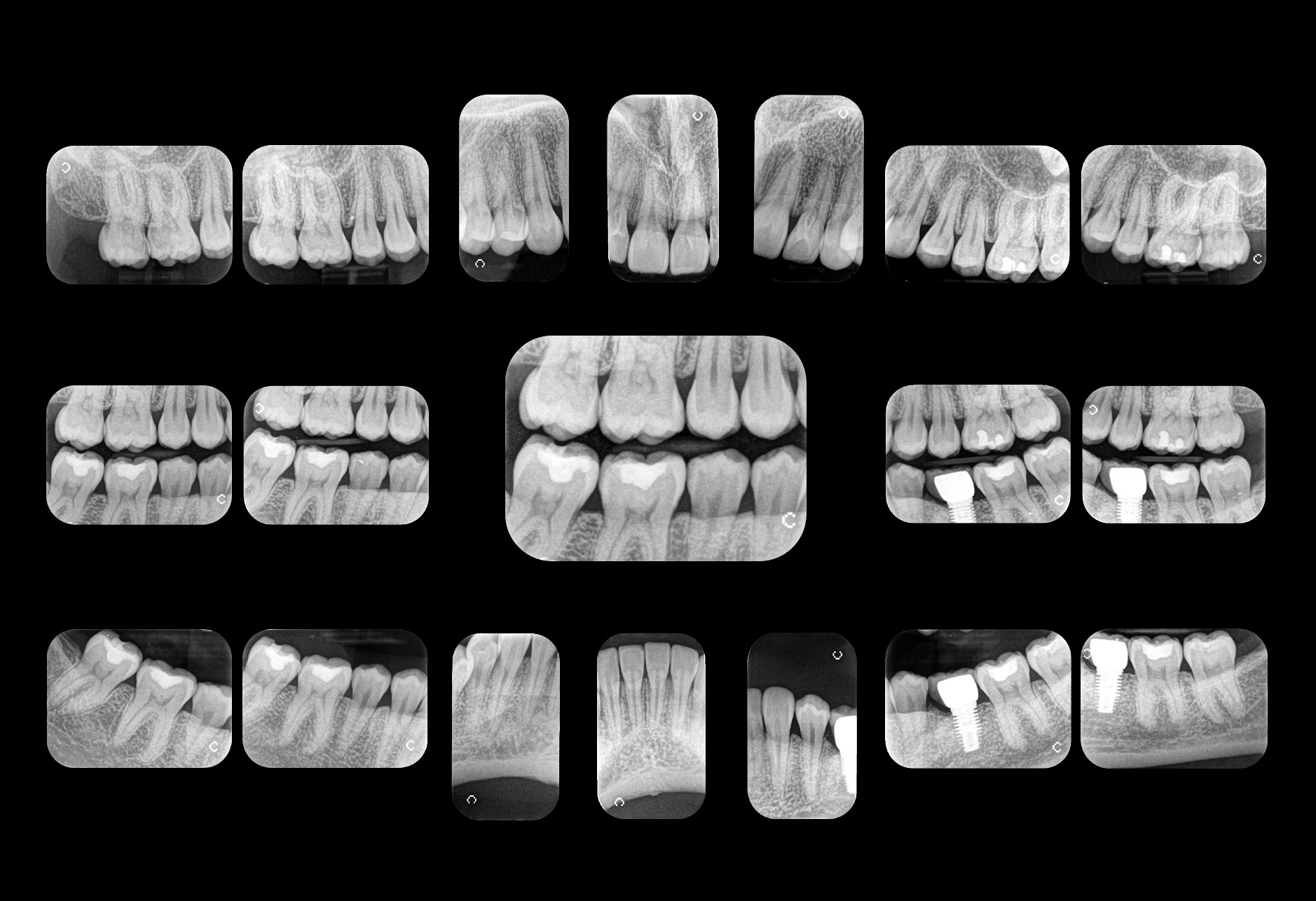 Intraoral Scans