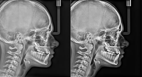 Lateral Cephalometric
